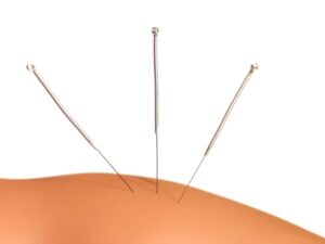 Acupuntura na Odontologia