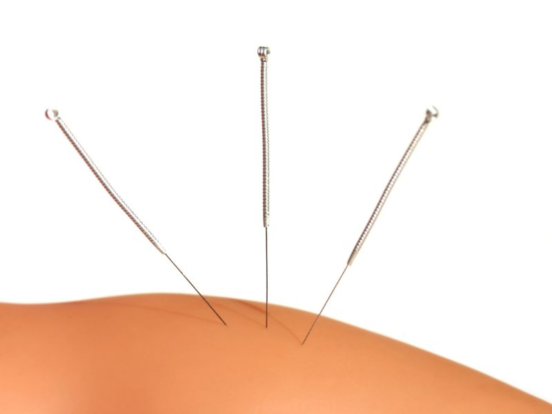 Acupuntura na Odontologia