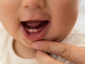 Bebê que nasceu com dentes