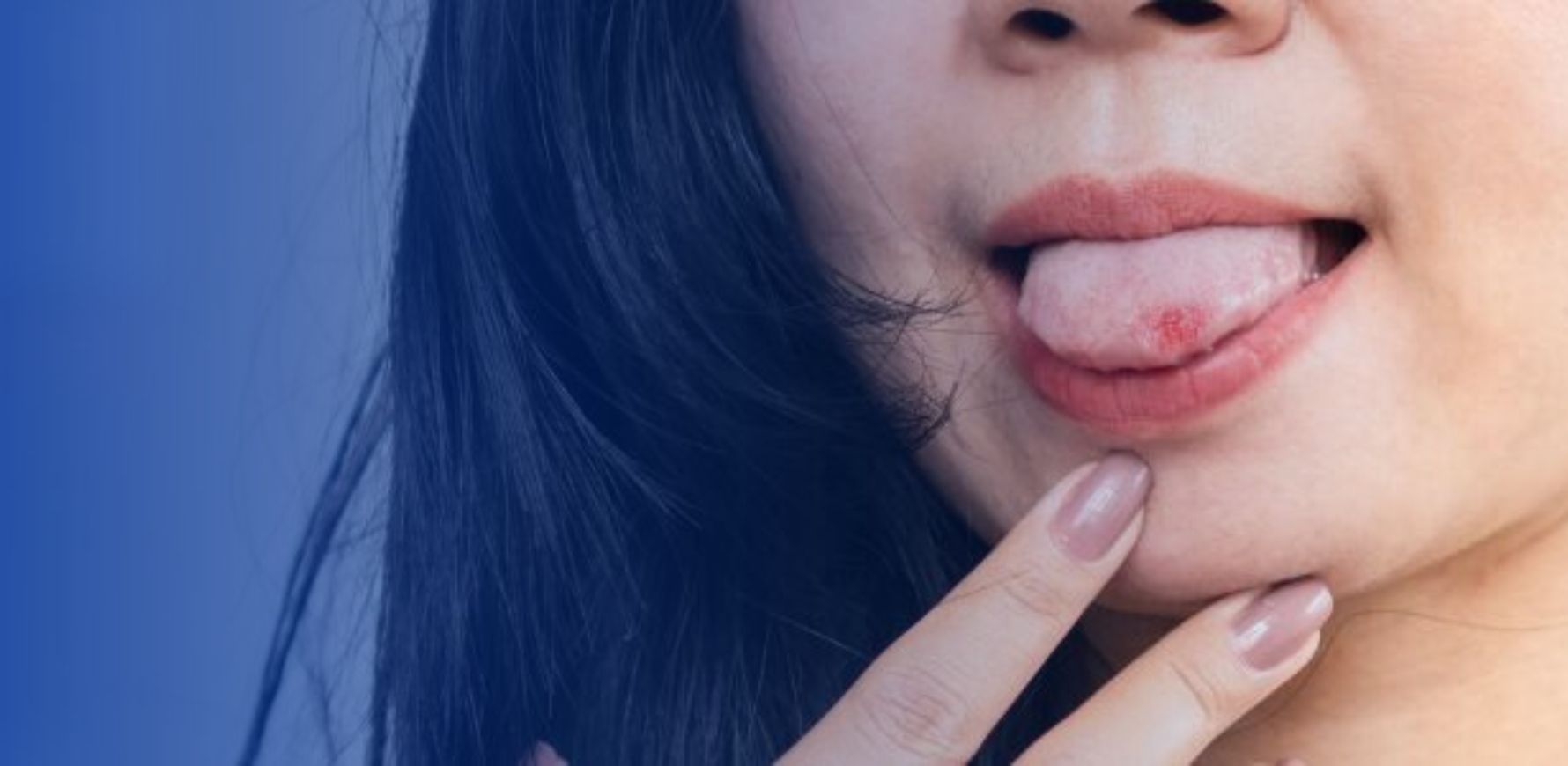 mulher com sindrome da ardencia bucal